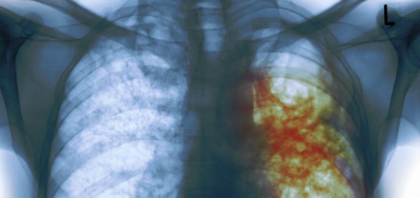 Tuberculosis on the Rise