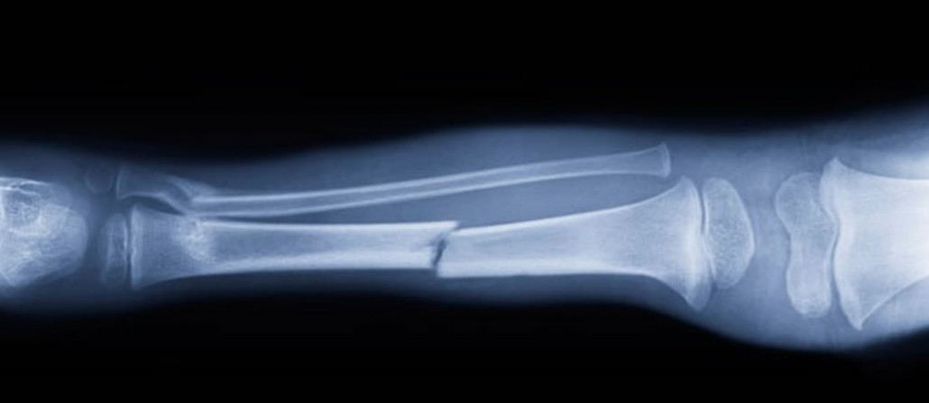 Открытый перелом кости руки. Рентгенограмма перелом кости. Закрытый перелом рентген. Лефорт 1 перелом рентген.